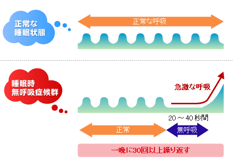 正常な睡眠状態と睡眠時無呼吸症候群