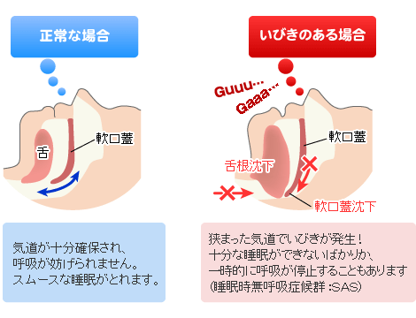 正常睡眠時といびきのある時の違い