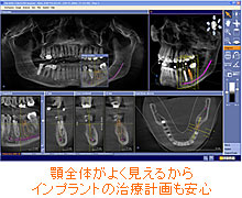 ＣＴスキャン＋３Ｄ診断システムガリレオス