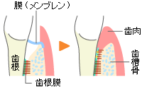 組織再生誘導法(GTR法)