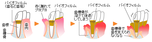 歯周病の進行