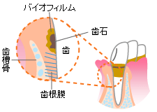 歯周炎