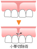 小帯切除術