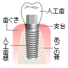 インプラント