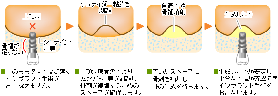 サイナスリフト法