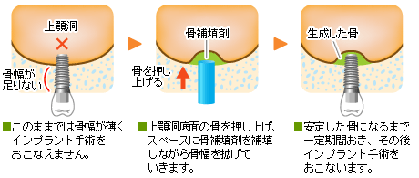 ソケットリフト法