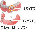 マグネットアタッチメント義歯