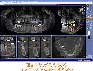 顎全体がよく見えるからインプラントの治療計画も安心