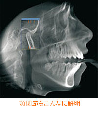 顎関節もこんなに鮮明