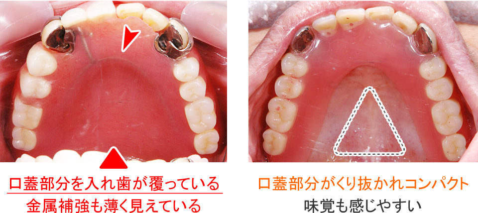 ミラクルデンチャーと一般的な部分入れ歯