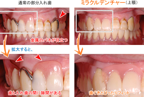 ミラクルデンチャーと一般的な部分入れ歯