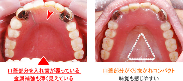 ミラクルデンチャーと一般的な部分入れ歯