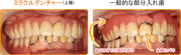 ミラクルデンチャーと一般的な部分入れ歯