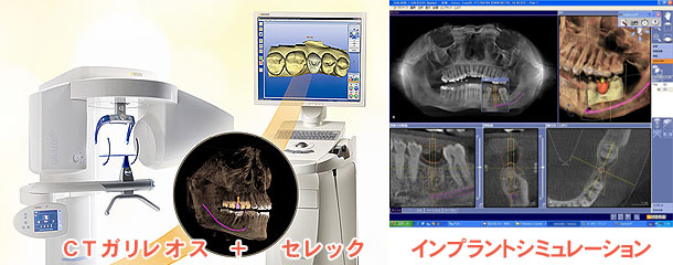 CTガリレオス＋セレック　インプラントシミュレーション